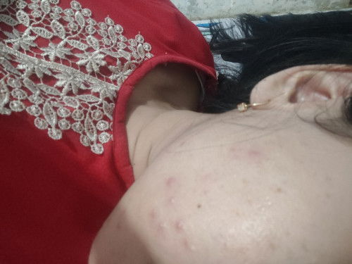 Bumil Jerawat meradang