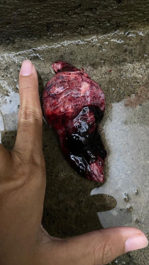 Gumpalan setelah pendarahan haid banyak