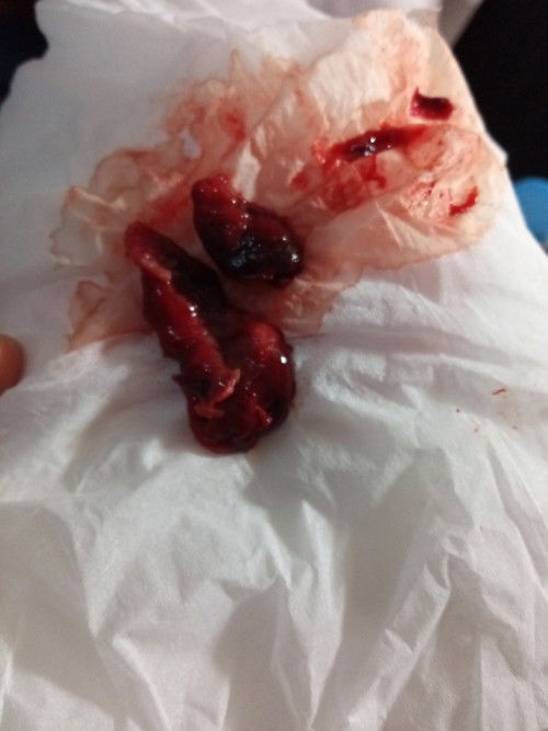 gumpalan setelah kuretasi