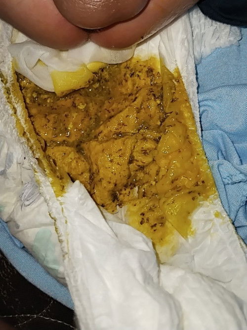 bunda²mau nanya dong pup bayi seperti itu berbahaya tidak ya?