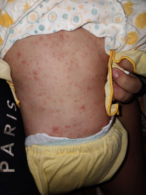 Bunda mau tanya ini bintik merah paada anak saya apa ya salapnya