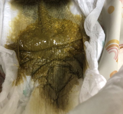 Kalau bf normal ke poop color hijau macam ni?