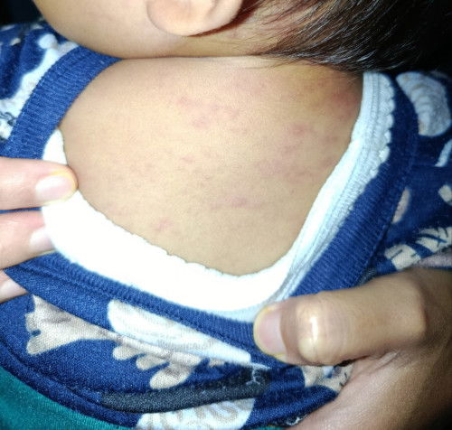 Ruam pada bayi 11 bulan