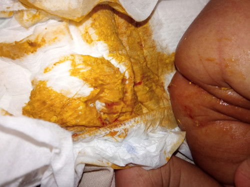 Pup bayi umur 28 hari ada lendir darah