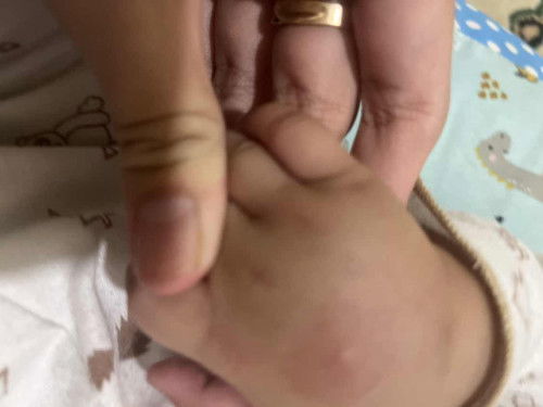 kepala bayi bentolan