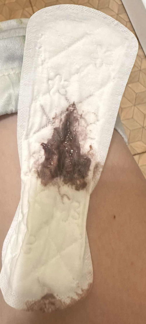 วันนี้6w พรุ่งนี้หมอนัดแล้วแต่ดันมาเลือดออกวันนี้ เลือดออกมาเป็นสีคนข้น เป็นอันตรายไหมคะทุกคนน้องจะเป็นอะไรไหม