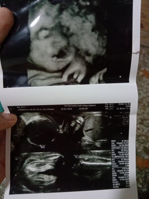 Hasil USG 33 week 
Kenapa bibirnya kaya ada yang aneh ya ?