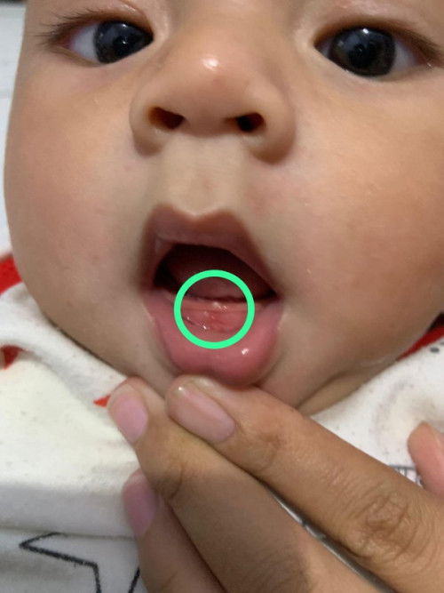 Tumbuh gigi/sariawan