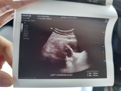 Cyst ovarian