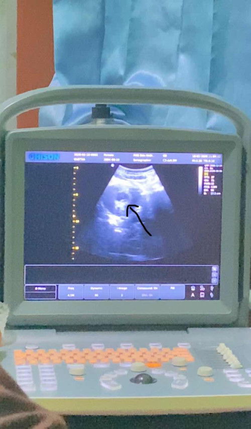 8week janin masih di bawah perut