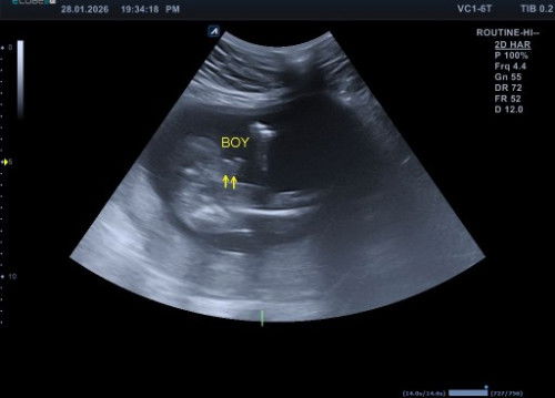 Kira kira kalo hasil usg gini udh pasti jk cowo belum si bun