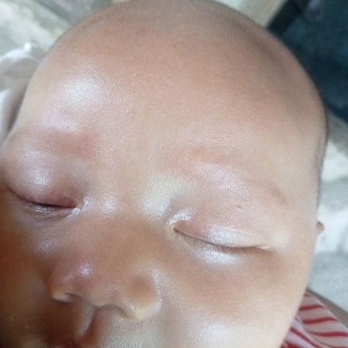 Bercak putih di kelopak mata kanan