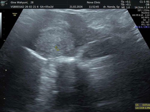 USG di 5week