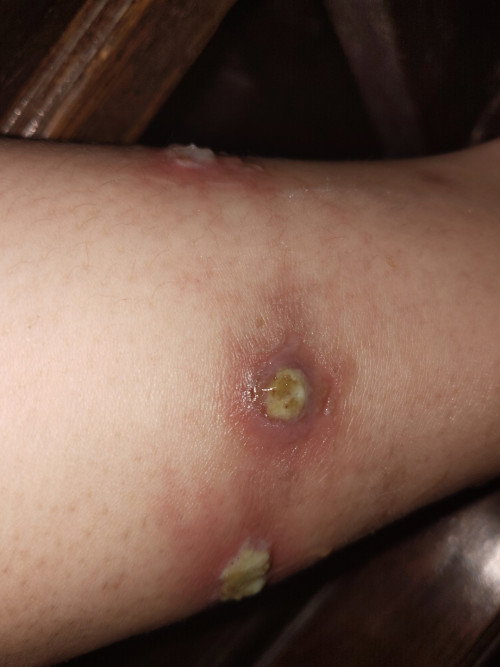 KAKI BERNANAH KORENGAN