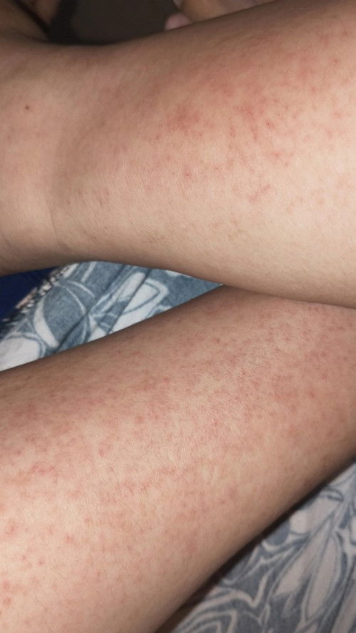 Gatal Ruam pada Kaki