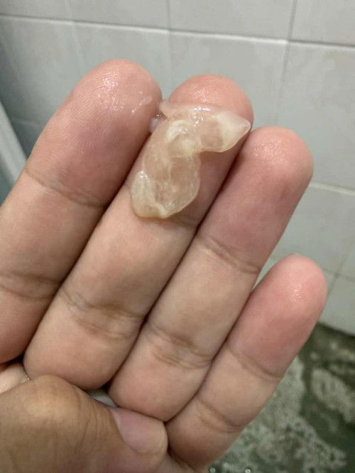 Mucus Plug @ 13 weeks 5 days