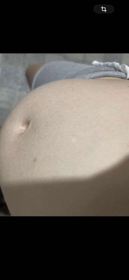 ผื่นขึ้นตรงท้องแต่ไม่คันเกิดจากอะไรคะใครเคยเป็นบ้าง