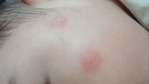 Anong insect po kya kumagat d2