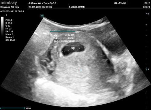 Diduga hamil bo tapi tidak ada flek dan nyeri apapun