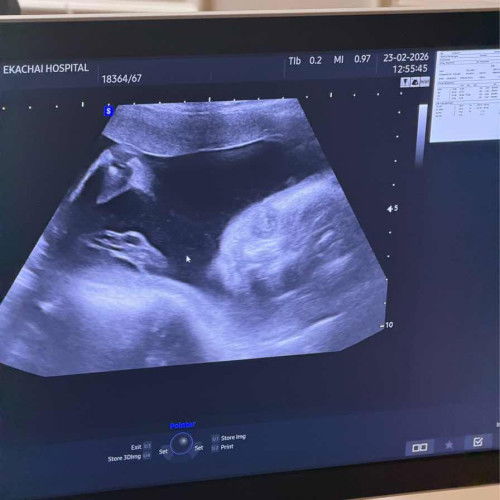 ปวดจี๊ดๆท้องข้างขวา