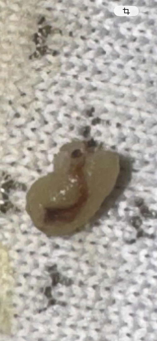 ตอนนี้ตั้งครรภ์ได้9w มีเส้นสีแดงแบบนี้ออกมาพร้อมตกขาว ปกติไหมคะ