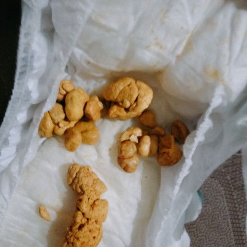 Bun,maaf klo jorok mau tnya KLO bayi full sufor umur 1bln pupnya kaya gini itu normal ga ya?