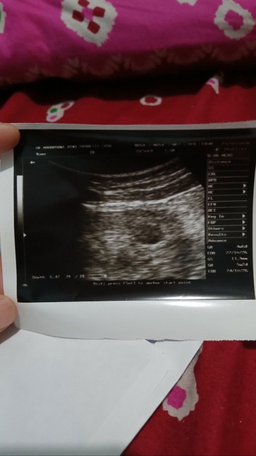 Ngeflek usia kandungan 5 minggu