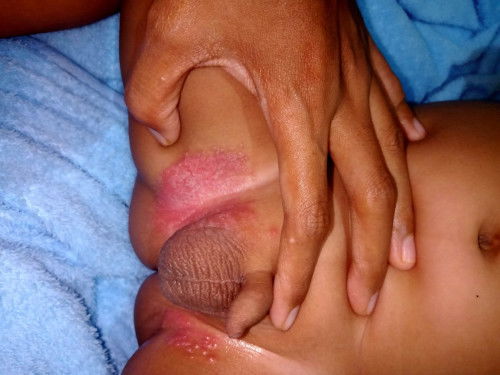 Sharring dong yg punya baby.. bayiku ruam gini boleh minta solusi buat penyembuhan