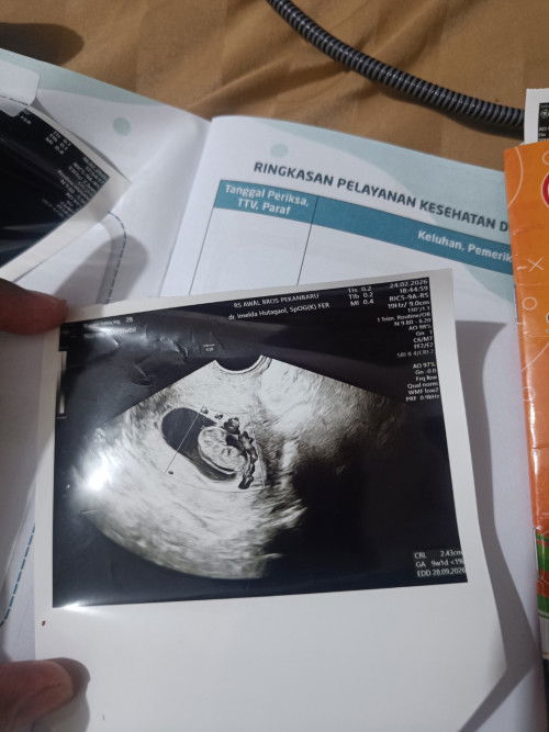 Denyut jantung hilang di W91d