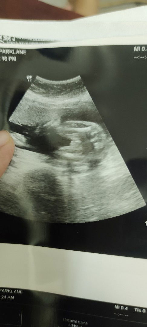 tumpang tnya mmy semua, tadi pergi scan 22weeks, doc kata macam boy.. boy or girl ye kalau macam ni?