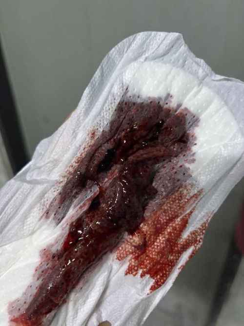 แบบนี้คือก้อนเนื้อที่น้องหลุดมั้ยคะ