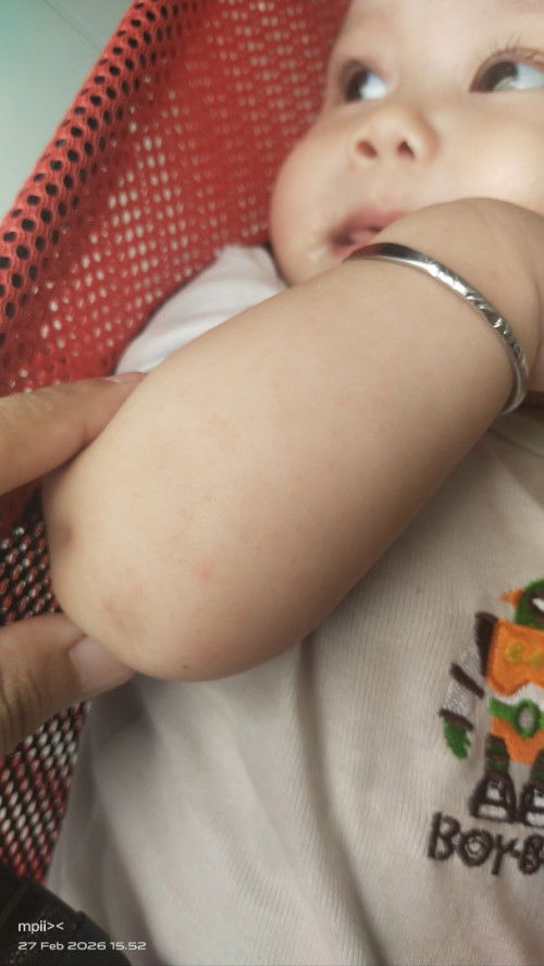 Badan bayi bintik² merah