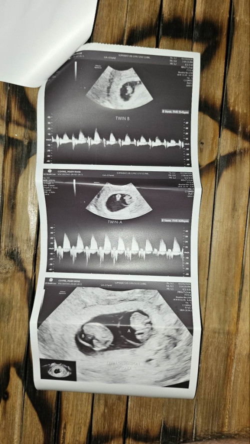 Hello mommies. Hoping that you are all good.

9 months after cesarean and now having twins 🥹