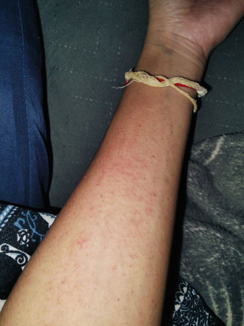 ลดแดงแผลเล็บขุดตามแขน