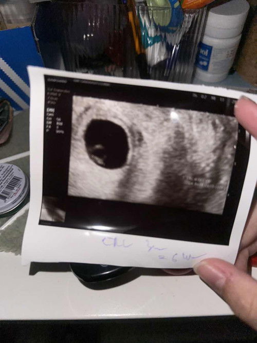 ขนาดตัวอ่อนไม่ถึงเกณฑ์