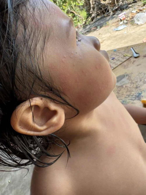 อยู่น้องมีผื่นขึ้นค่ะ