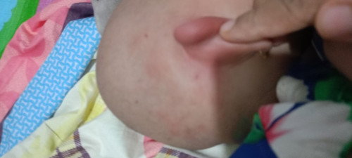 Daun Telinga bengkak merah gatal