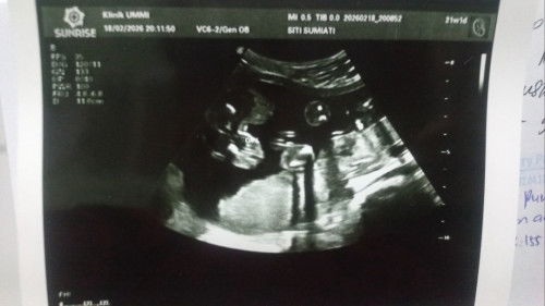 USG 21minggu JK baby girl