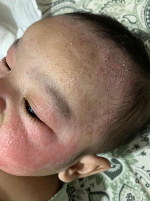 HeLp! Sesiapa pernah deal dengan ruam/ eczema baby :(