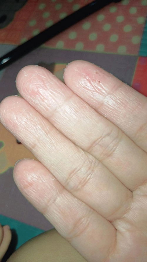 Bun aku smnjk abis lahiran tgn ku jdi gni pdhl sblmnya g pernah mn kdg gatel ada yg tau obatnya g?