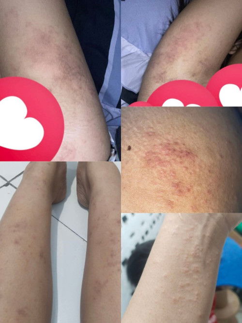 Gatal gatal ruam sebadan