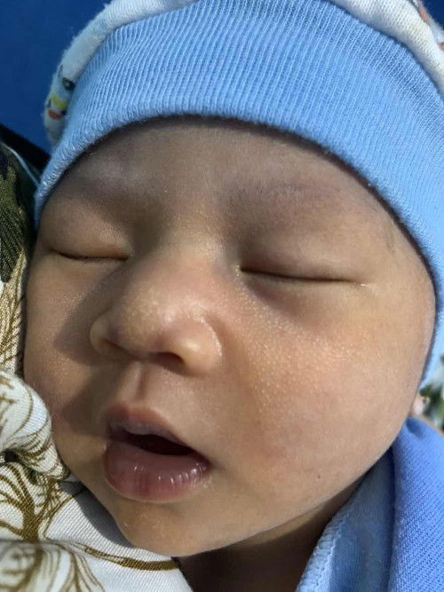 bintik bintik putih di wajah