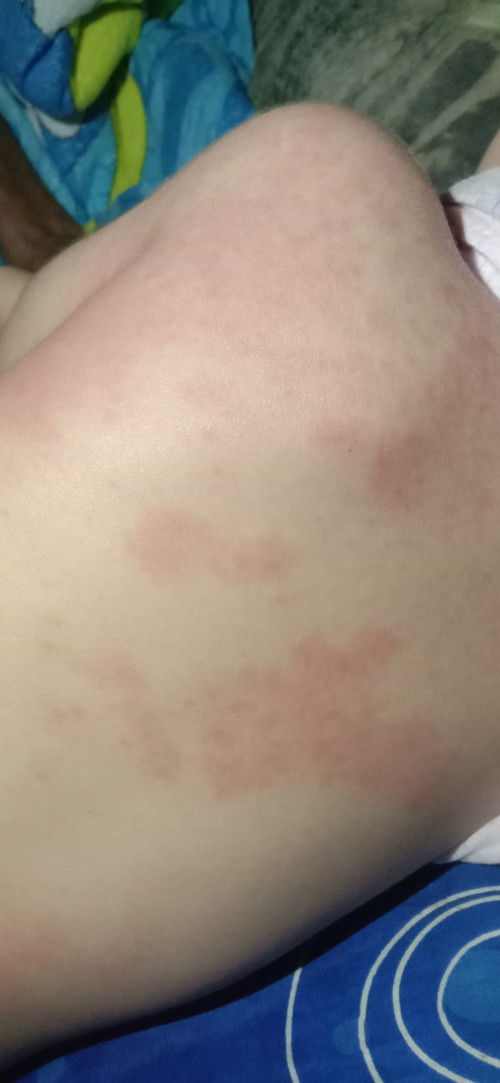 Tlg donk bund jika mengalami hal seperti ini,badan anak saya muncul bintik-bintik merah,lalu melebar