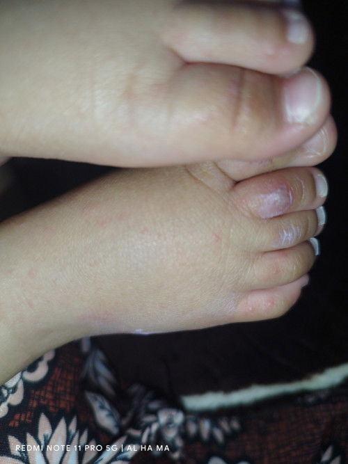 Bunda ini anak saya seperti gatal dan ada cairan didalamnya apa obatnya ya ?