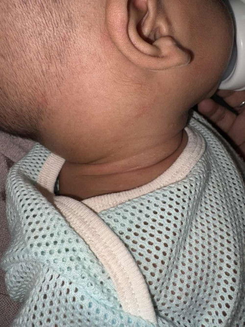 Ruam & Bintik Merah Leher Baby 3 Bulan