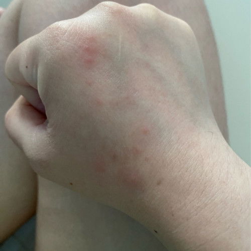 ไตรมาส3 ขึ้นเป็นตุ่มแบบนี้ตามแขนมือและขาปกติไหมคะ คันมากๆเลยค่ะ ทายาได้ไหมคะ