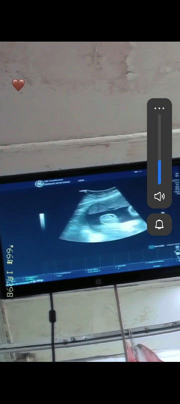 saya tanya apa pendapat ibu ii yang tengok gambar jantina baby dalam scan.