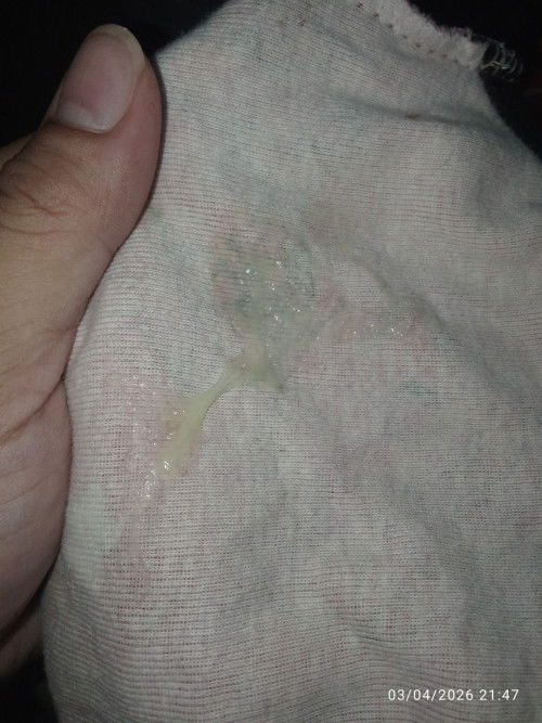 Discharge or Mucus Plug?