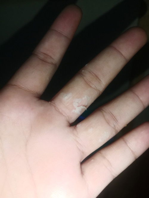 Kalo kaya gini kenapa yaa? Awalnya gatal, terus merah bintik² dan akhirnya kaya ganti kulit gini