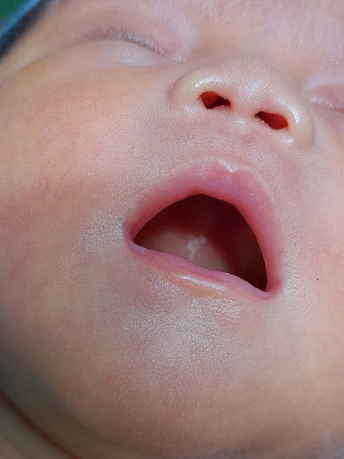 Bintik² di atas mulut bayi nerborn